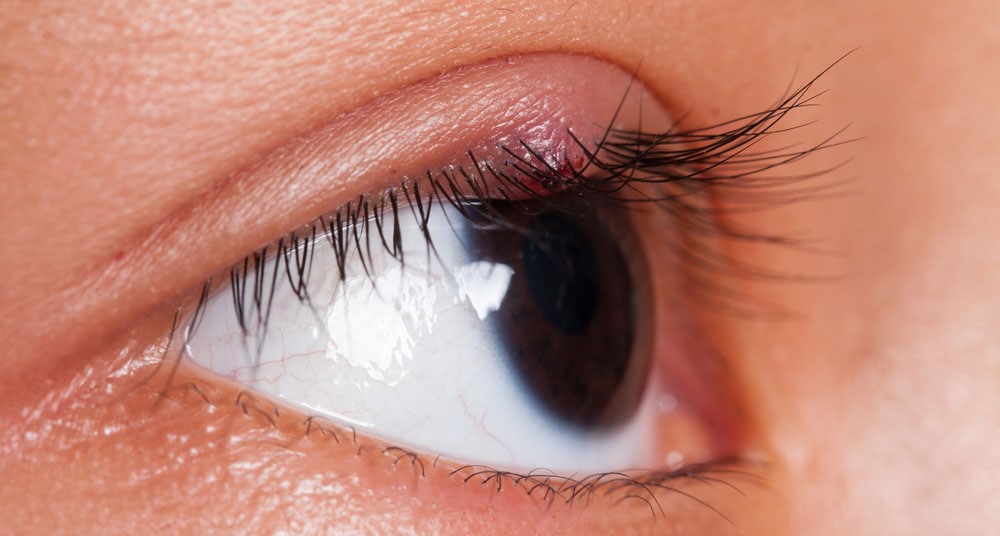 Is That a Stye or a Chalazion? What the Heck is a Chalazion?