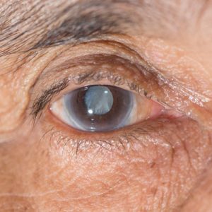 Cataract Eye Treatment