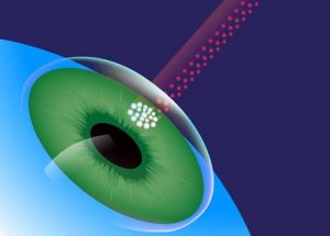 LASIK Laser Scan