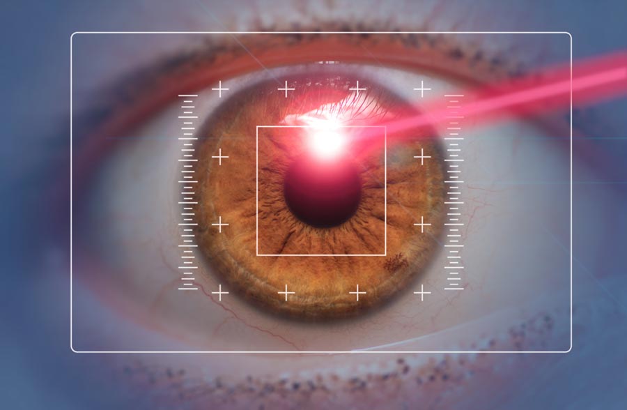 LASIK Laser Scan