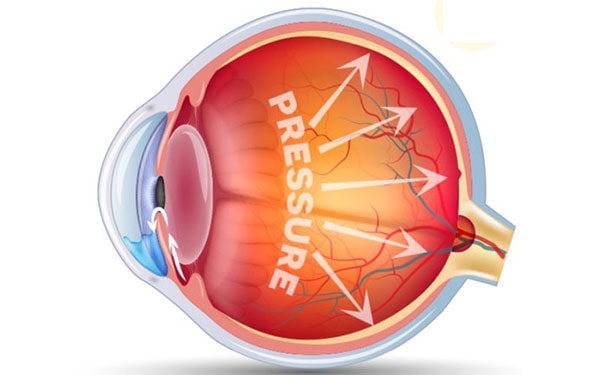 The Durysta implant for Glaucoma