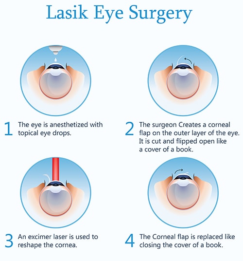 How LASIK eye correction works