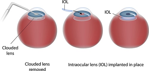 Cataract Surgery - Implanting Intraocular Lens