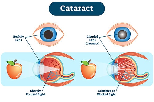 Healthy Eye vs Cataracts