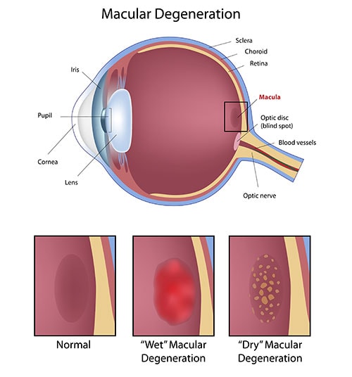Labeled diagram of a normal eye, dry macular degeneration, and wet macular degeneration