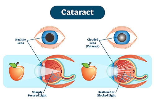 Illustration of a healthy eye vs cataract