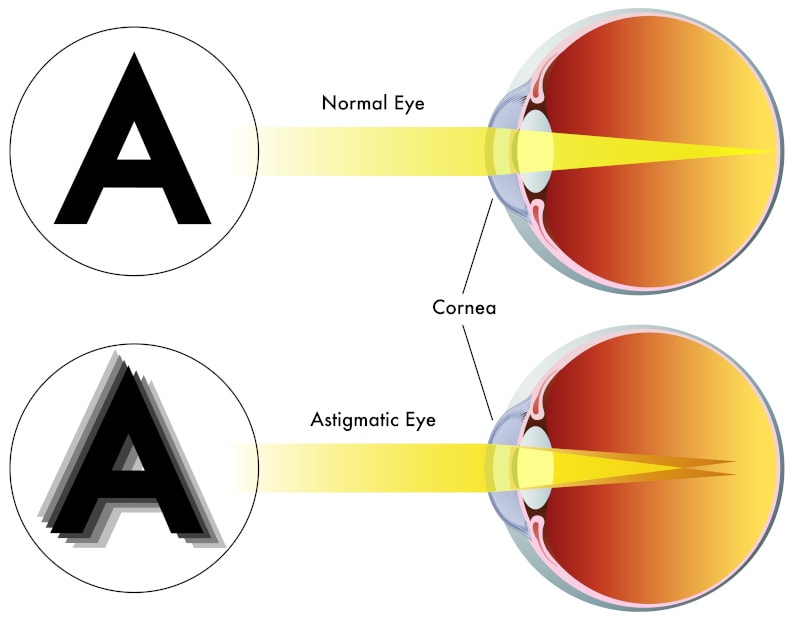 Illustration of astigmatism eye