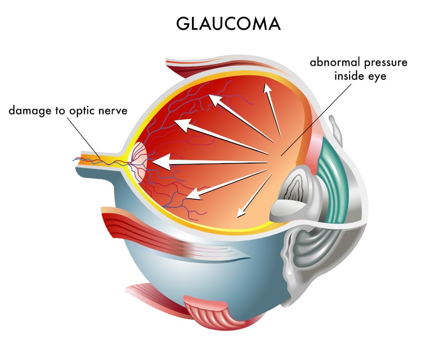 Diagram of glaucoma eye