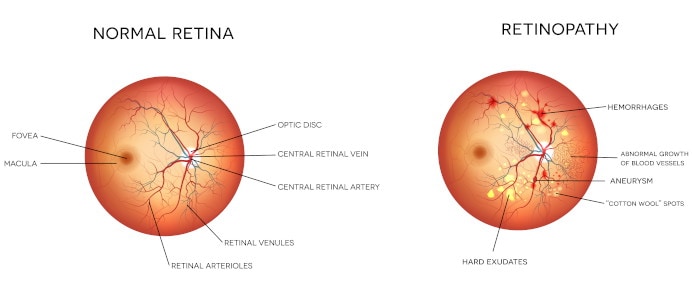 illustration of a healthy retina versus retinopathy