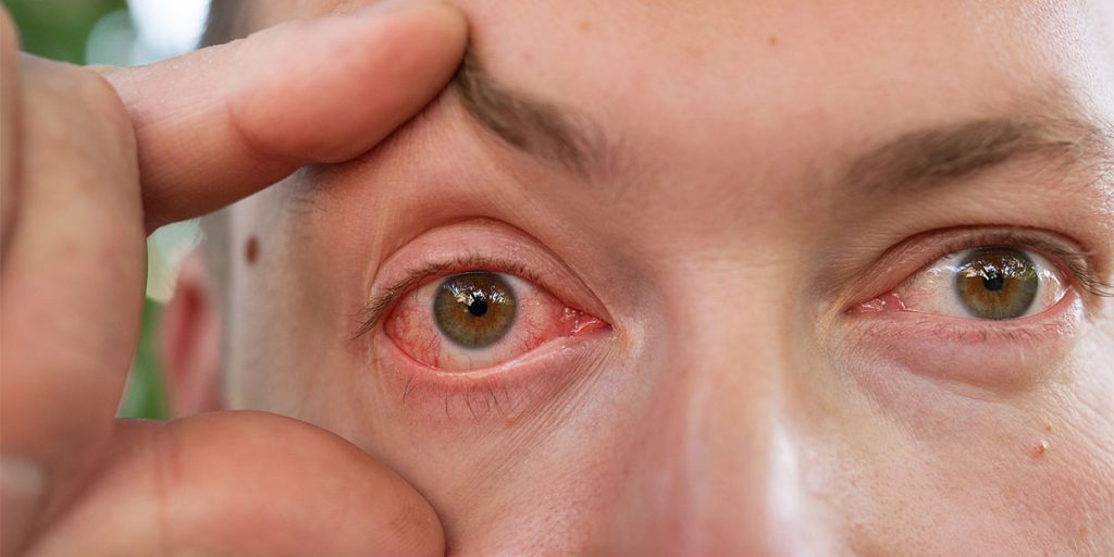 Iritis: causes and treatment, man with irritated eye, Assil Gaur Eye Institute
