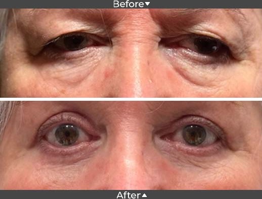 Blepharoplasty Before and After Image, Assil Gaur Eye Institute Beverly Hills