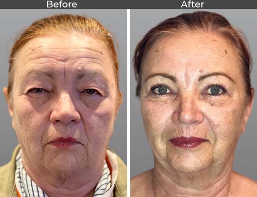 Blepharoplasty before and after