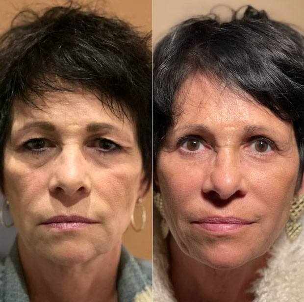 Karen before and after blepharoplasty