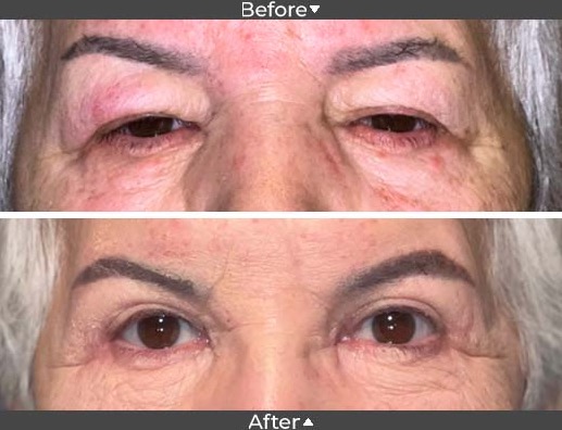 Ptosis  for saggy eyes, Assil Gaur Eye Institute of Los Angels