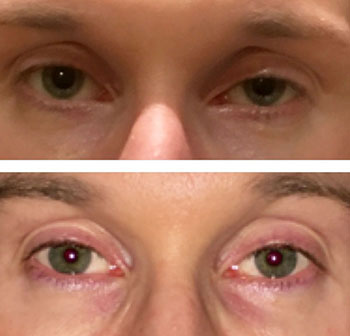 revision uneven eyelids