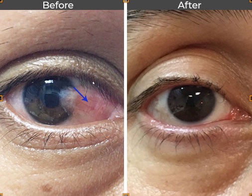 Pterygium, Surfers Eye, Assil Gaur Eye Institute