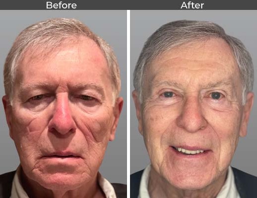 ptosis before and after images