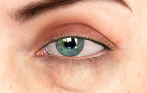 Dermatochasis, Eyelid conditions, Assil Eye Institute