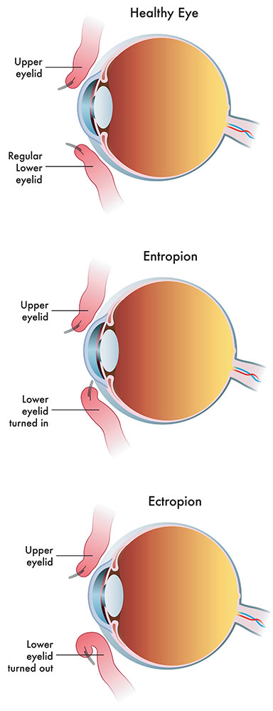 Entropion Surgery