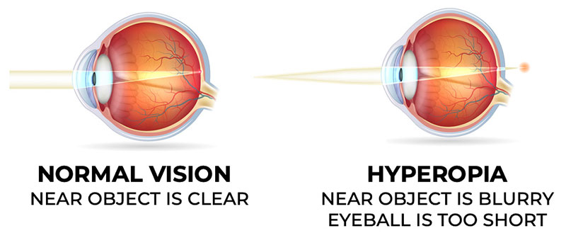 Hyperopia Visual Representation - Assil Eye Institute
