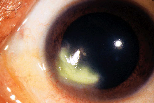 Cornea Conditions | Assil Gaur Eye Institute Los Angeles