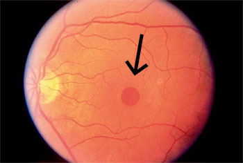 macular hole)