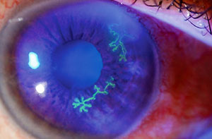 Herpesul ocular poate cauza pierderea vederii?
