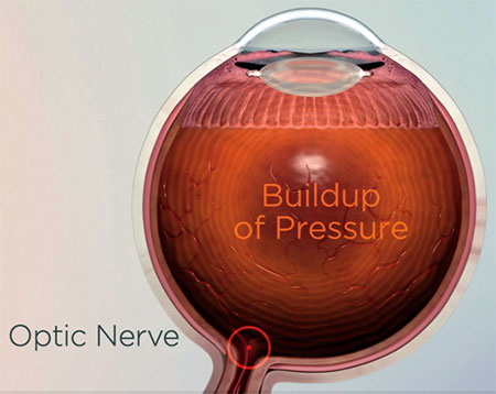 Eye pressure from Glaucoma, Assil Gaur Eye Institute of Los Angeles
