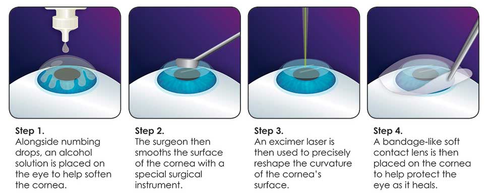 PRK procedure laser eye surgery, Assil Eye Institute