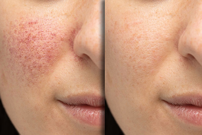 Photofacial before and after