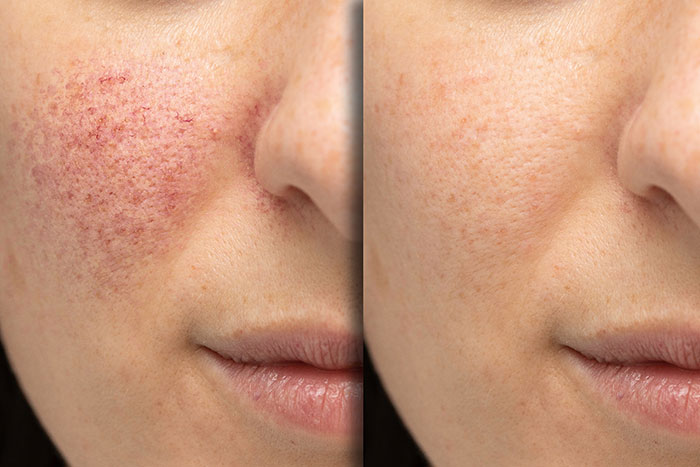 Microneedling