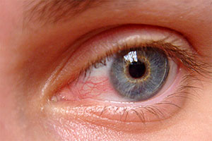 Pterygium (surfer's eye): causes, symptoms and treatments