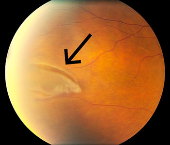 partially torn retina