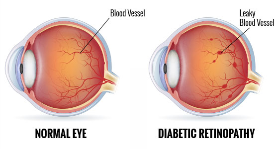 Diabetic retinopathy, Assil Eye Institute Los Angeles