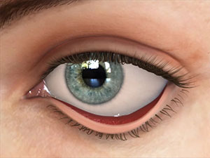 Eye lid Conditions, Ectropion, Assil Eye Institute