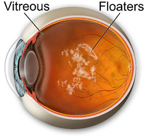 YAG procedure for eye floaters, Assil Eye Institute