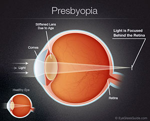 Presbyopia, Old Eye, Assil Eye Institute