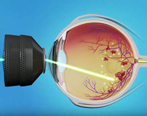 Retinal Laser Surgery, Assil Eye Institute