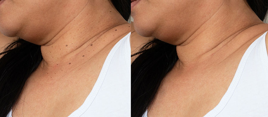 Skin tag removal Los Angeles