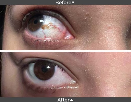 conjenctival nevas removal, Assil Gaur Eye Institute