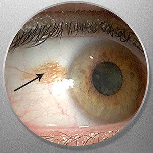 Eye freckle, Assil Eye Institute, Conjunctival Nevus Removal