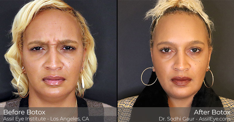 Botox at Assil Eye Therapy