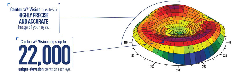 Contoura vision LASIK Laser surgery