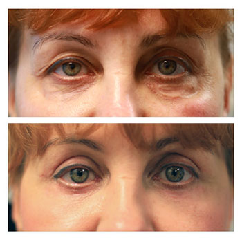 Puffy Eyes and Bags with Eyelid Surgery