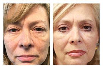 Blepharoplasty