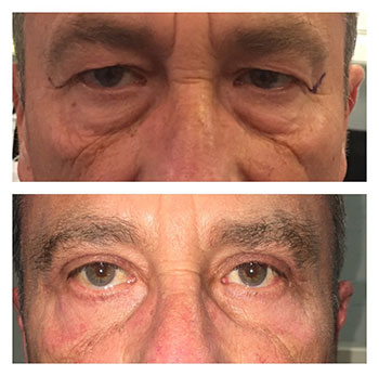 upper blepharoplasty gone wrong