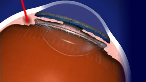 What Is Chronic Angle-Closure Glaucoma? - American Academy of Ophthalmology
