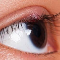 Stye in My Eye or a Chalazion - Assil Gaur Eye Institute