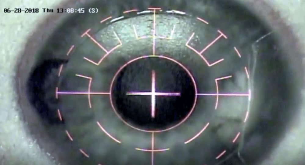 The projected laser reticle falls entirely within the exposed stroma allowing the ablation to be safely performed without encroaching on the hinge