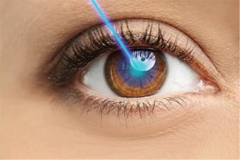 EagleVision®️ LASIK Surgery available at Assil Gaur Eye Institute
